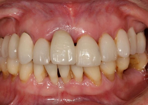 Dental Implants: Case 6 - Before