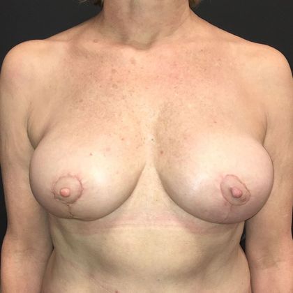 DIEP Flap Breast Reconstruction Case 49 - After
