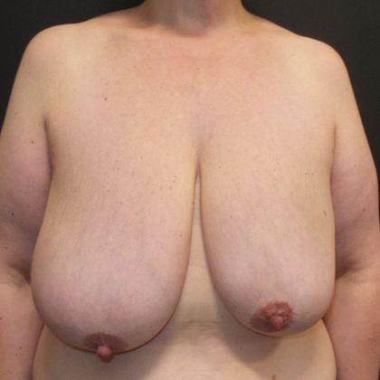 DIEP Flap Breast Reconstruction Case 50 - Before