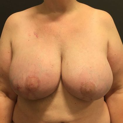 DIEP Flap Breast Reconstruction Case 50 - After