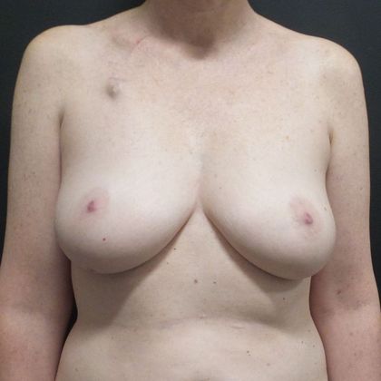 DIEP Flap Breast Reconstruction: Case 53 - Before