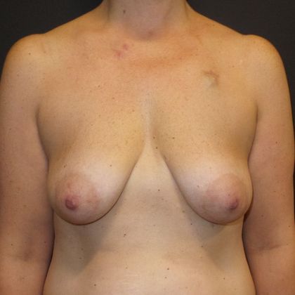 DIEP Flap Breast Reconstruction Case 54 - Before