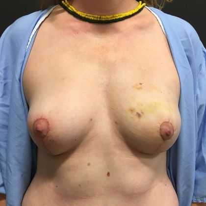 DIEP Flap Breast Reconstruction Case 55 - After