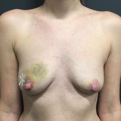 Implant Breast Reconstruction Case 16 - Before