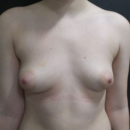 Implant Breast Reconstruction Case 3 - Before