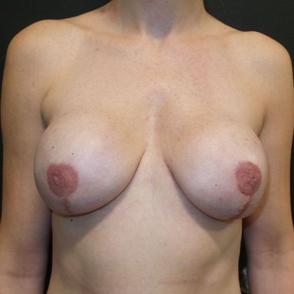 Implant Breast Reconstruction Case 18 - After