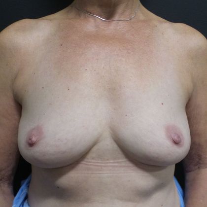 Implant Breast Reconstruction Case 19 - Before