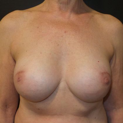 Implant Breast Reconstruction Case 19 - After