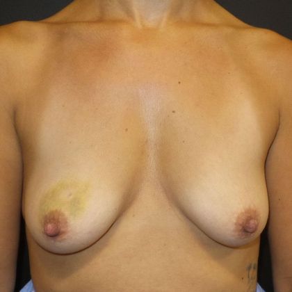 Implant Breast Reconstruction Case 21 - Before