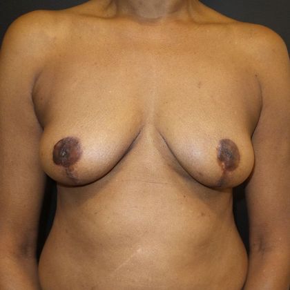 Oncoplastic Breast Reconstruction Case 9 - After
