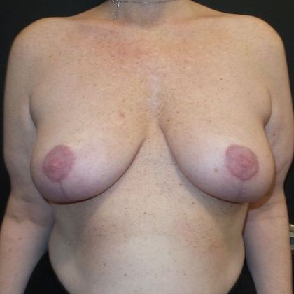 Oncoplastic Breast Reconstruction Case 11 - After
