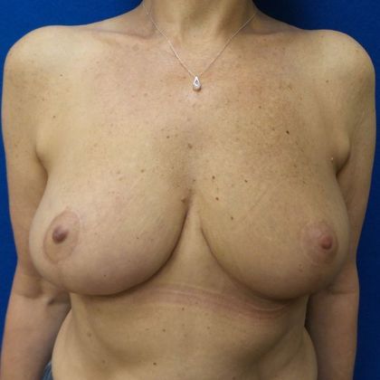Oncoplastic Breast Reconstruction: Case 13 - After