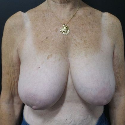 Oncoplastic Breast Reconstruction Case 16 - Before