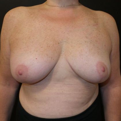 Oncoplastic Breast Reconstruction Case 17 - After