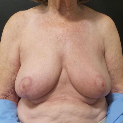 Oncoplastic Breast Reconstruction: Case 21 - After