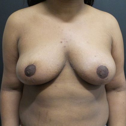 Breast Reduction Case 18 - After