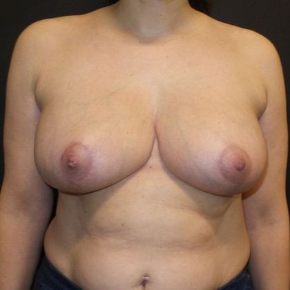 Breast Reduction: Case 19 - After