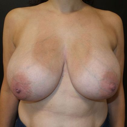 Breast Reduction: Case 19 - Before