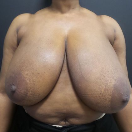 Breast Reduction Case 24 - Before