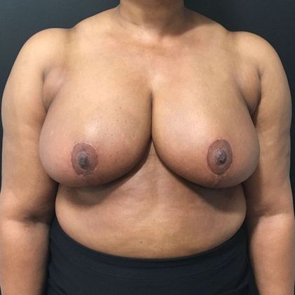 Breast Reduction Case 24 - After