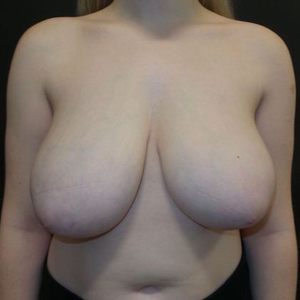 Breast Reduction: Case 25 - Before