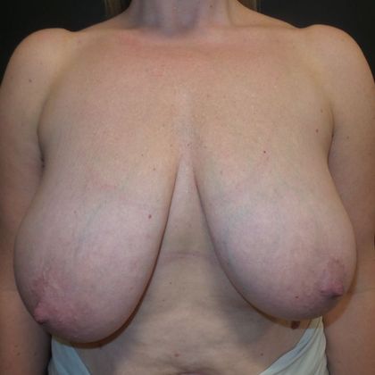 Breast Reduction Case 27 - Before
