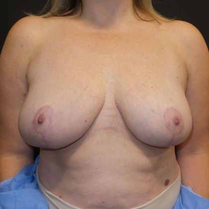 Breast Reduction Case 27 - After