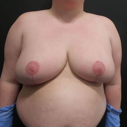 Breast Reduction Case 34 - After