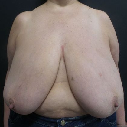 Breast Reduction: Case 35 - Before