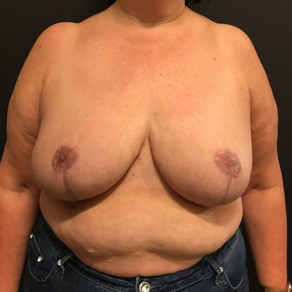 Breast Reduction: Case 35 - After