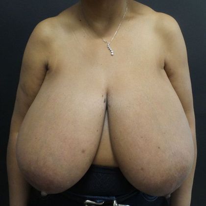 Breast Reduction: Case 40 - Before