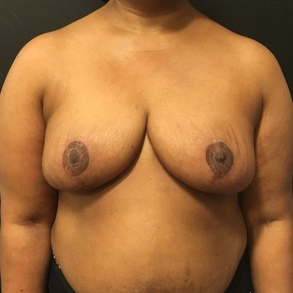 Breast Reduction: Case 41 - After