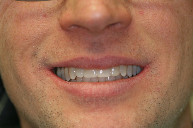 Invisalign Cases