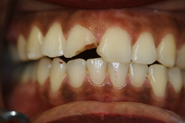 Cosmetic Bonding Case