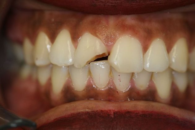 Cosmetic Bonding Case 1 - Before