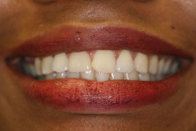 Cosmetic Bonding Case 1 - After