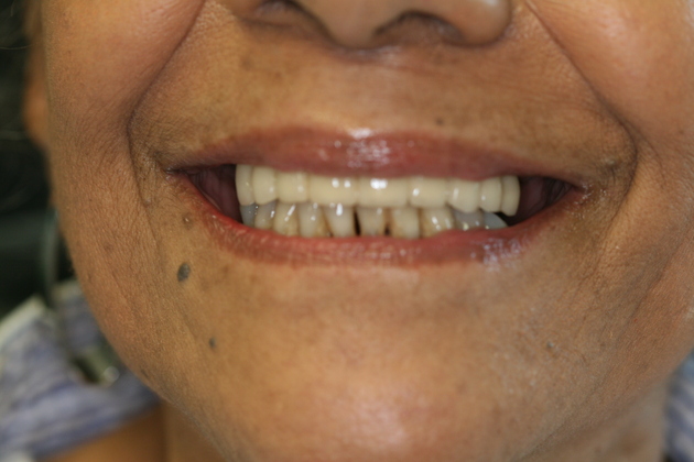 Crown and Bridge Case