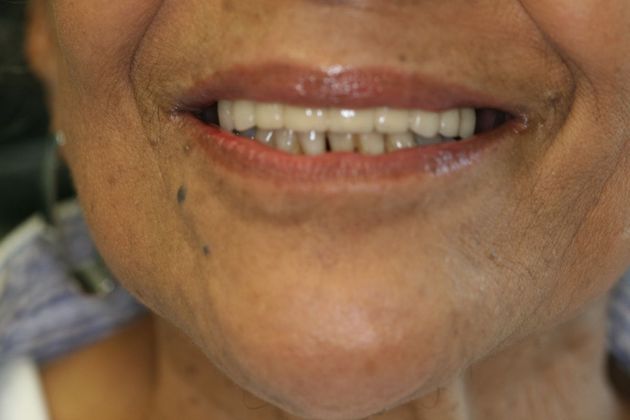 Crown and Bridge Case 1 - After