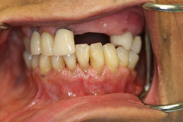 Crown and Bridge: Case 1 - Before