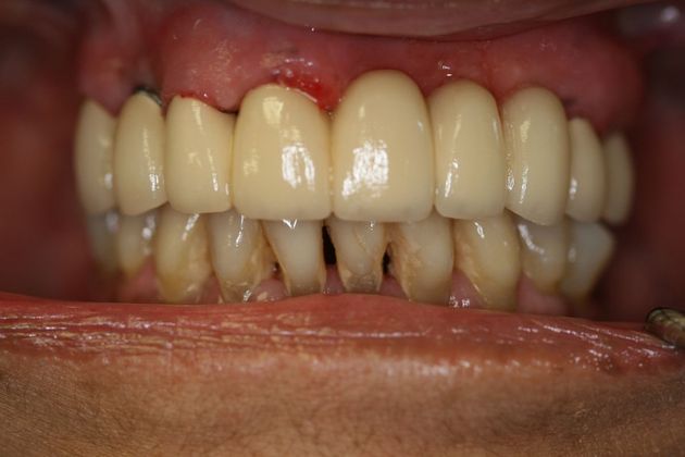 Crown and Bridge: Case 1 - After