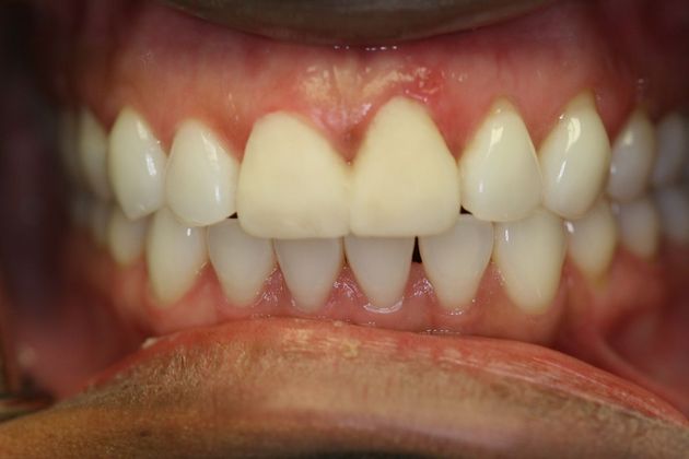Orthodontics & Veneers: Case 4 - Before