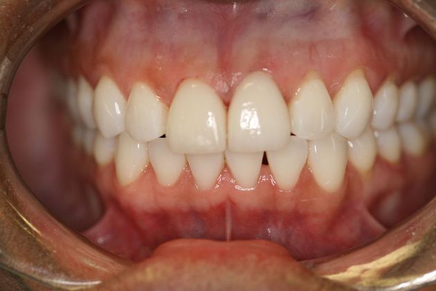 Orthodontics & Veneers: Case 4 - After