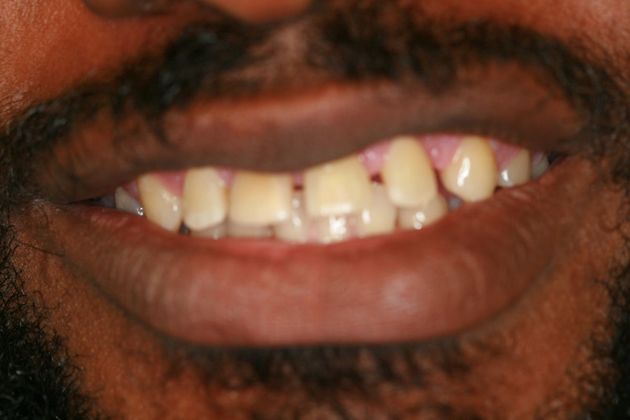 Porcelain Veneers Case 4 - Before