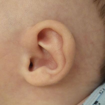 Ear Molding: Case 1 - After