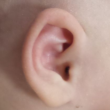 Ear Molding: Case 2 - After