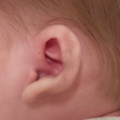 Ear Molding: Case 4 - Before