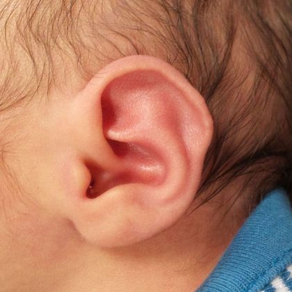 Ear Molding Case 5 - Before