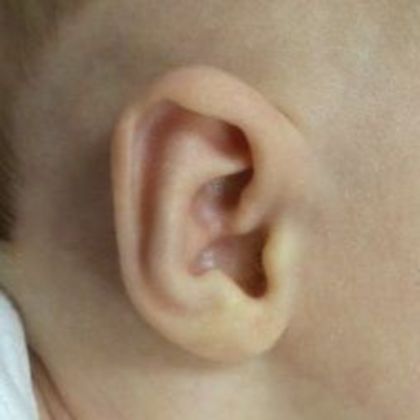 Ear Molding: Case 6 - After