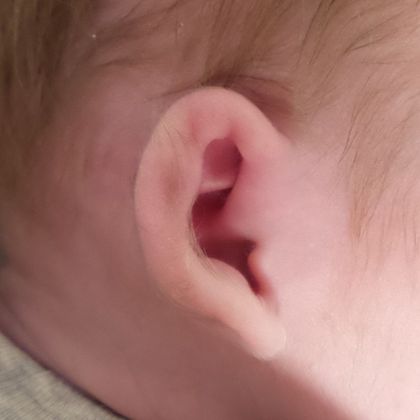 Ear Molding Case 7 - Before