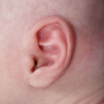 Ear Molding: Case 9 - After